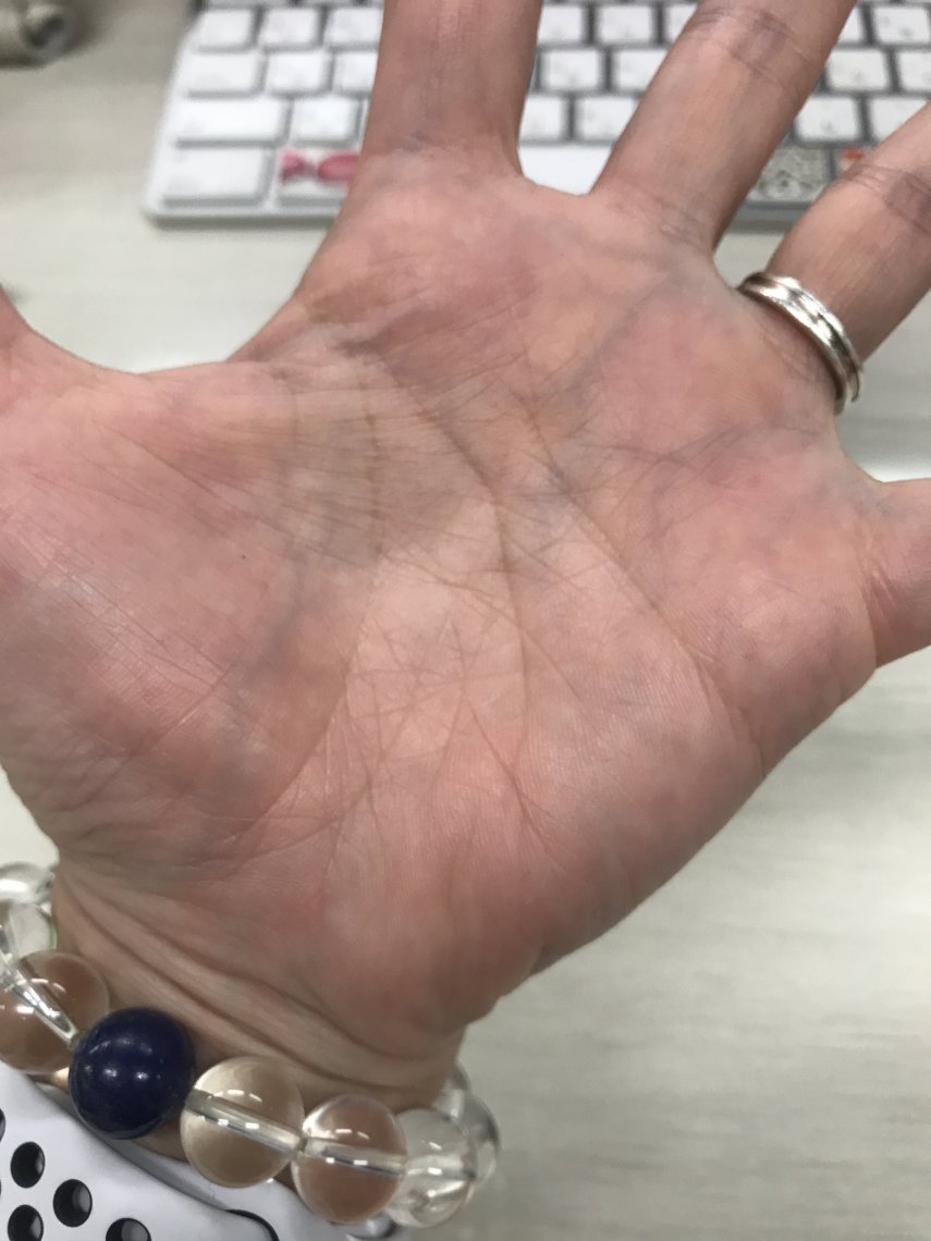 手のひら の 血管